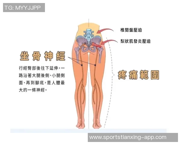 专家解读坐骨神经痛成因及治疗方法大多数患者可避免手术治疗
